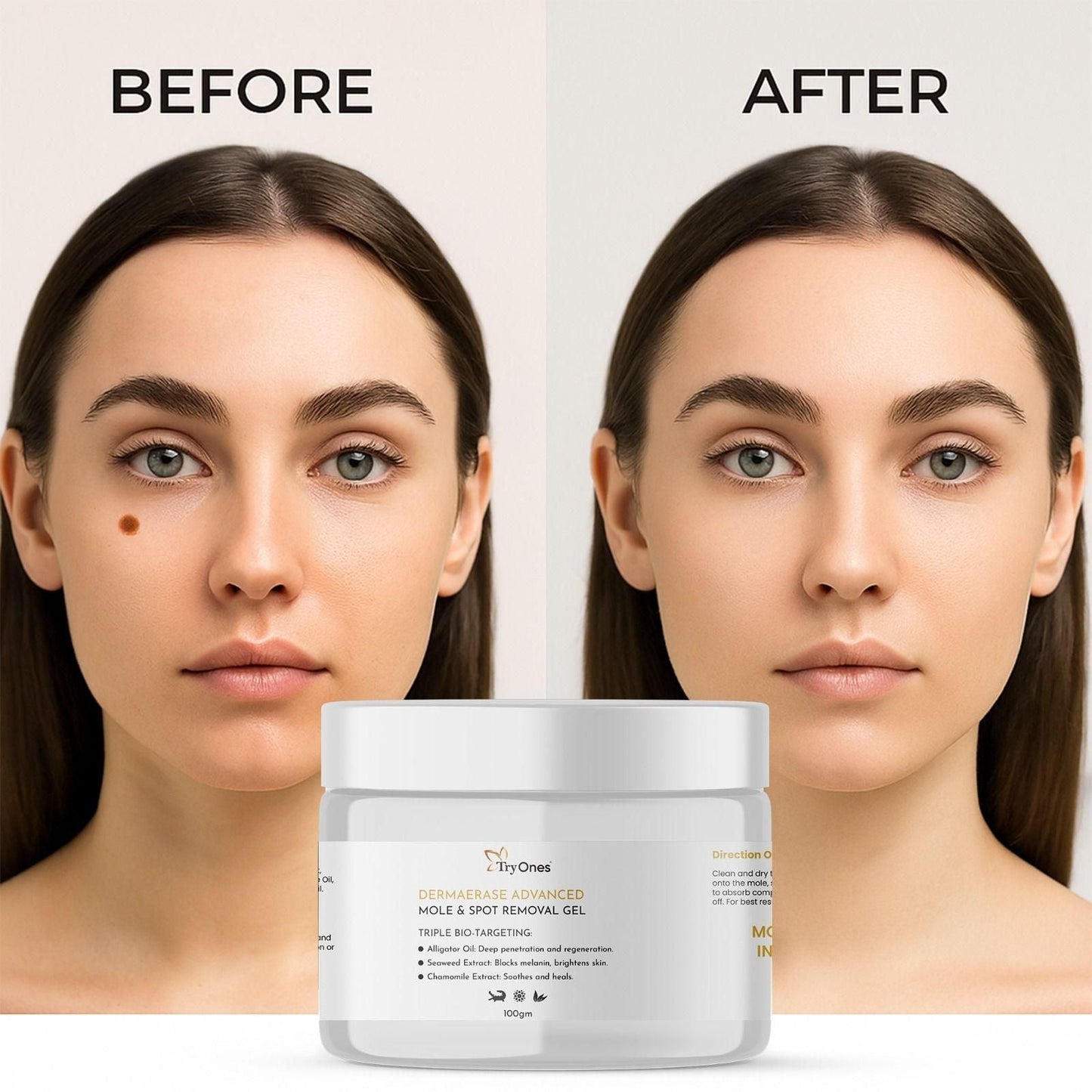 Mole and Spot Removal Gel 200 gm Pack of 2